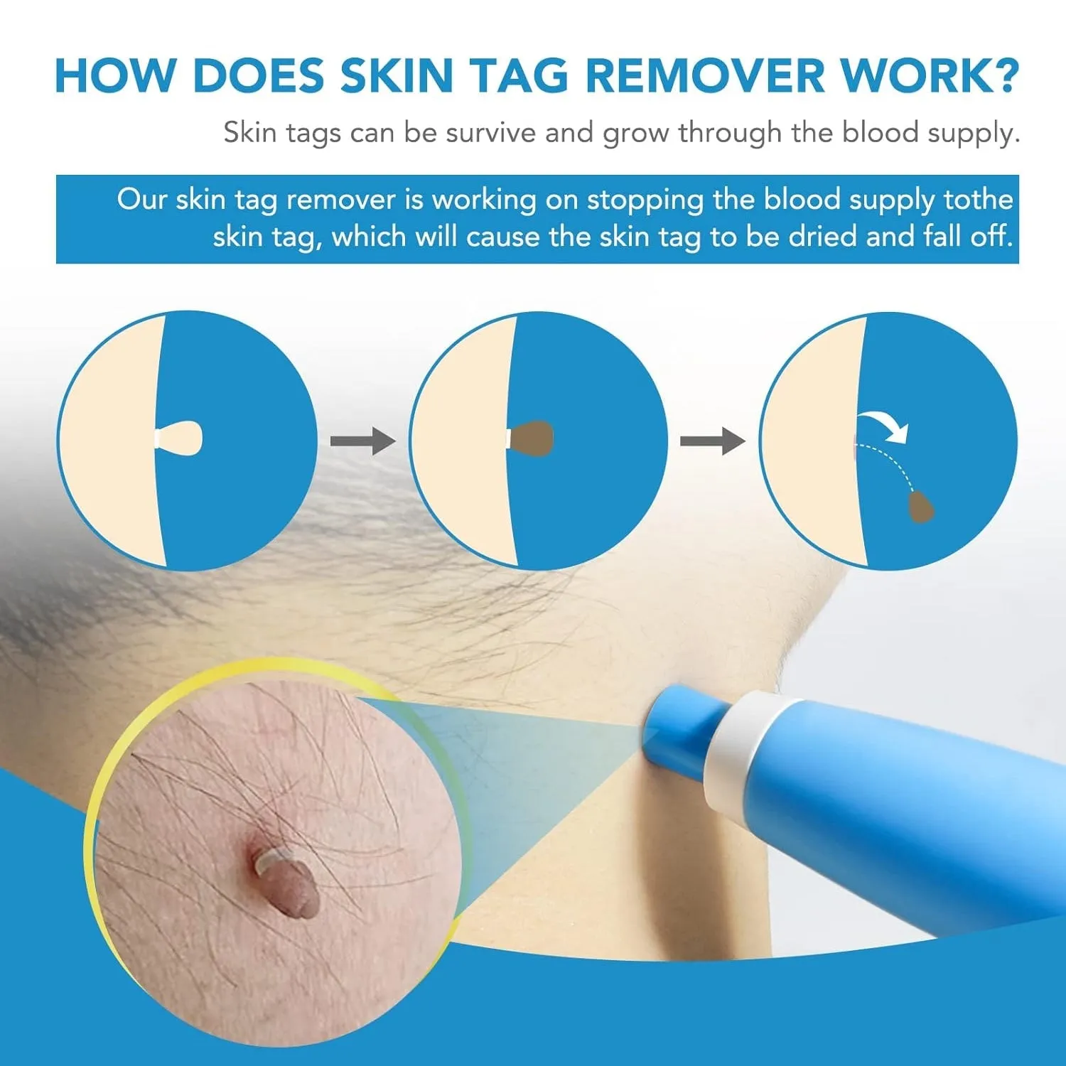 Skin Tag Remover Kit 2 in 1 for Micro to Large (2 mm - 8 mm / 1 Set)