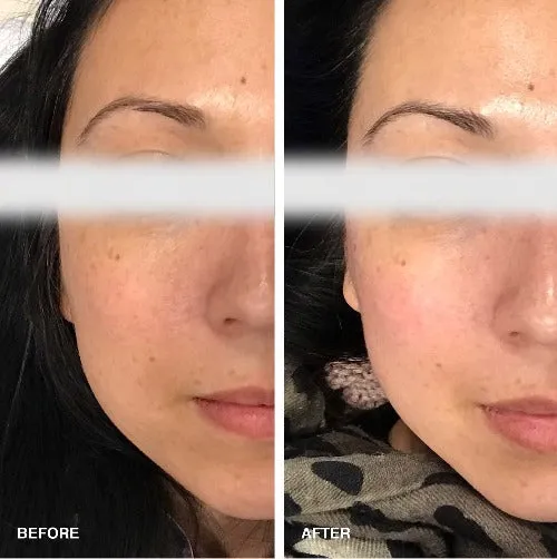 TE360 Radio Frequency for Anti-Aging